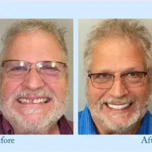 Hidone™ – Premium-Zahnprothese