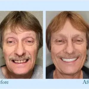 Hidone™ – Premium-Zahnprothese