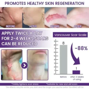 Acezozla® ReGenScar Stem Cell Scar Gel